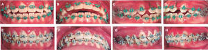 A-D) Retraction of the interdental segments phase with a bull loop. E-H) Final phase of treatment with intermaxillary elastics.