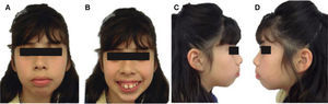 Fotos extraorales: A) Frontal, B) sonrisa, C y D) perfil derecho e izquierdo.