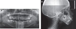 Radiografías iniciales. A) Radiografía panorámica. B) Lateral de cráneo.