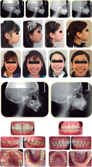 Comparación de fotos iniciales y finales extraorales, intraorales y radiografía lateral de cráneo.