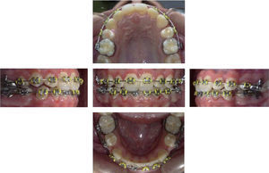 Mecánica inferior para pérdida de anclaje.