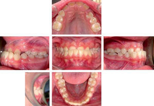 Intraoral analysis in centric relation. An anterior crossbite, deviated dental midlines, bilateral class I molar relationship undetermined canine relationship, upper and lower ovoid abscence of the upper canines and mild lower crowding are observed.