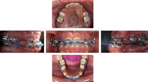 Upper and lower stainless steel archwires, open coils on the upper arch from the lateral incisors to the second premolars. On the lower arch an elastomeric chain was placed from molars to canines for retraction.
