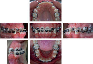 Upper 0.014” nitinol archwires were placed for canine inclusion, lower 0.016 x 0.025 nitinol archwires to level prior to the reraction of the lower anterior segment. The lingual arch was removed.