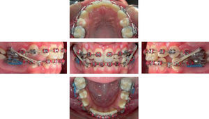 0.019 x 0.025” upper nitinol archwires and 0.019 x 0.025” SS lower archwires with crimpable hooks, class III elastics and active lace backs to retract the lower anterior segment. A new class II relationship is observed.