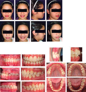 Initial and final facial and intraoral comparative photographs.