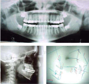 Final radiographs. Initial and final cephalometric tracings with Ricketts analysis. Anchorage loss in the upper arch, proclination of the upper incisors and retroclination of the lower were observed. There were no significant changes.