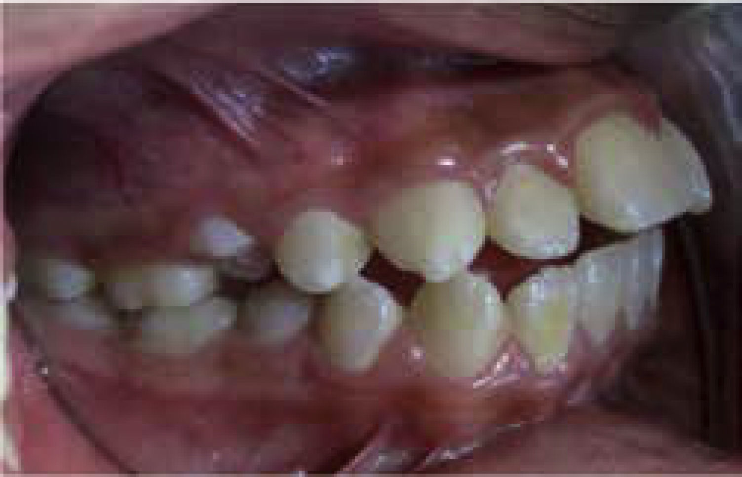Fifteen months of treatment with Tip-Edge system of a class II division ...
