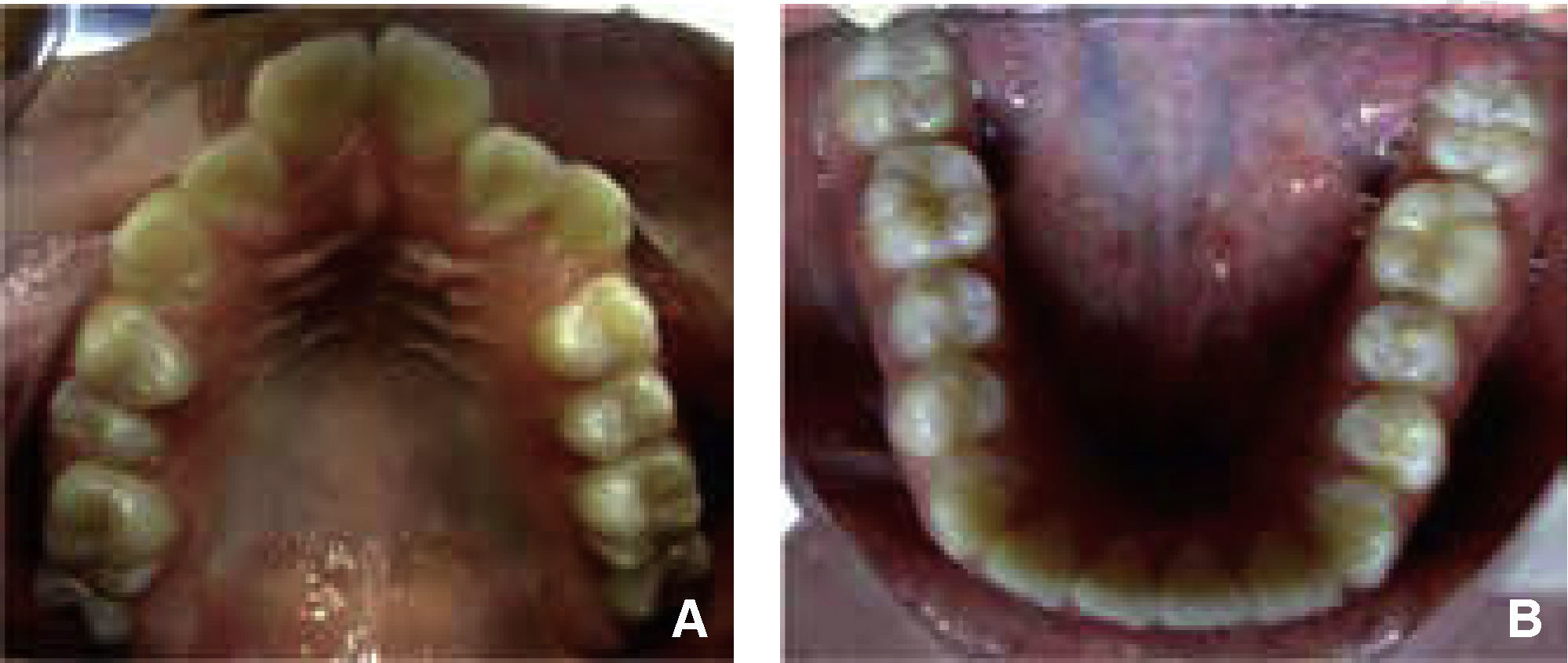 Fifteen months of treatment with Tip-Edge system of a class II division ...