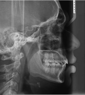 Radiografía lateral de cráneo final.