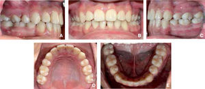Final intraoral photographs: A) Right, B) Frontal, C) Left, D) Upper occlusal view and e. lower occlusal view.