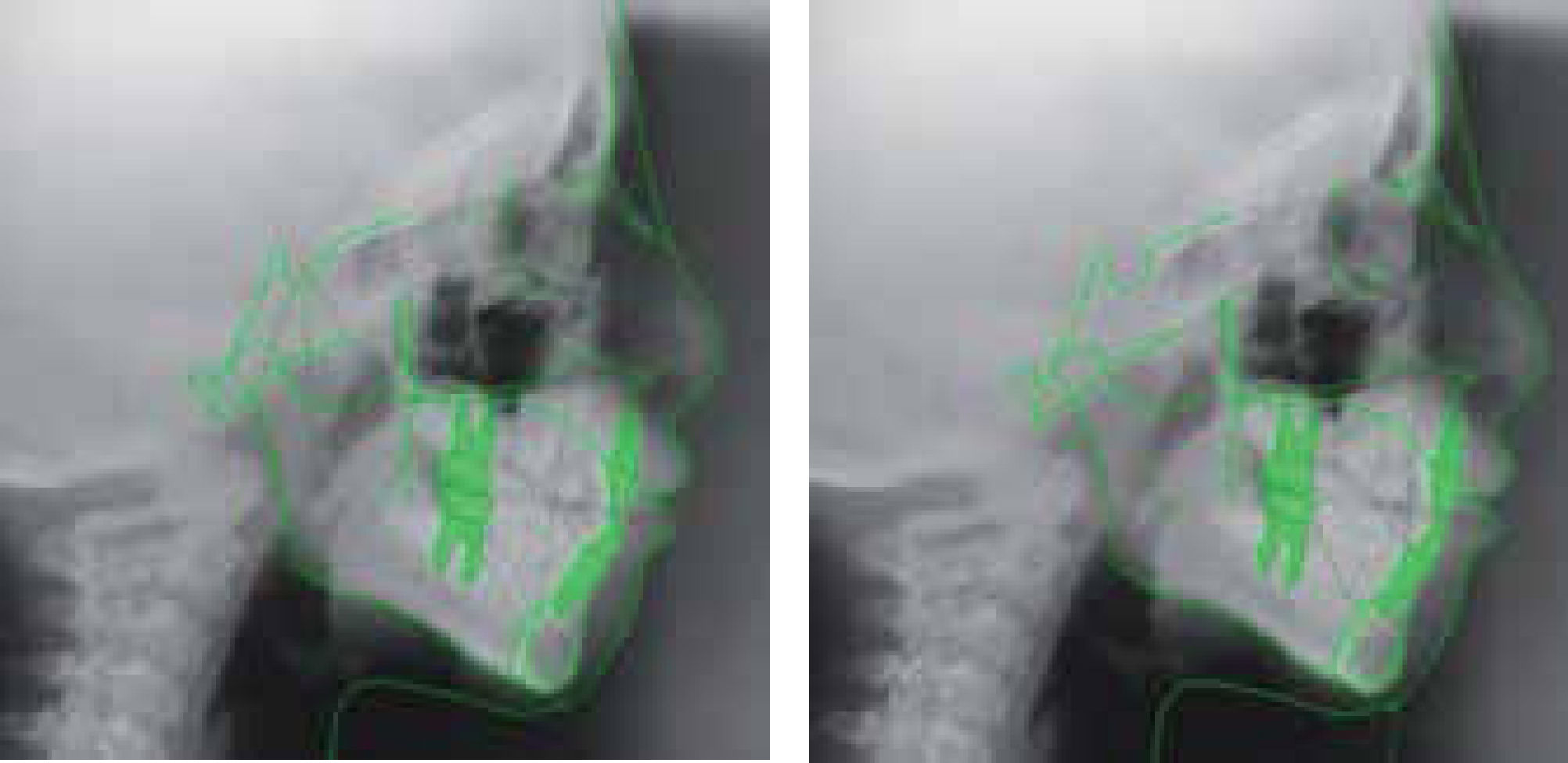 Treatment of bilateral cleft lip and palate with maxillary collapse ...
