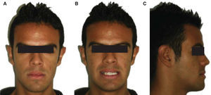 Initial facial examination. A. Frontal view, B. Smile C. Profile.