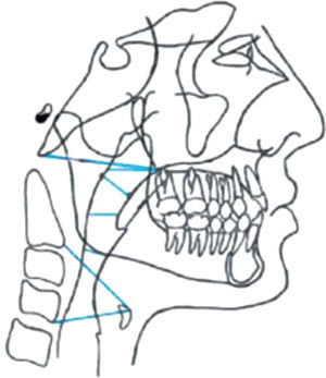Cephalometric measurements for the upper airway.