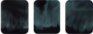 Periapical radiographs where a diminished root length was observed.