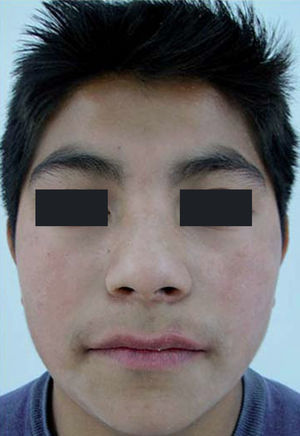 Fotos extraorales frontales después del tratamiento de ortopedia.