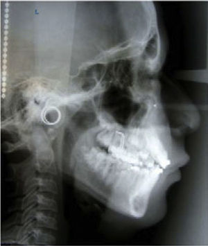 Radiografía lateral de cráneo después del tratamiento.