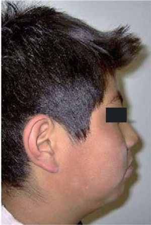 Fotografía de perfil del paciente antes del tratamiento.