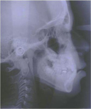 Radiografía lateral de cráneo antes del tratamiento.