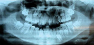 Radiografía panorámica. Senos maxilares normales, ramas mandibulares asimétricas, la derecha de mayor tamaño, cóndilo derecho más delgado y más alto, 28 piezas dentales erupcionadas, 9 piezas no erupcionadas.