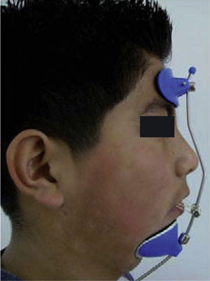 Vista lateral de la máscara facial de vástago vertical.