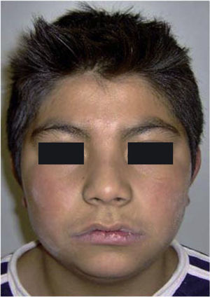 Pre-treatment frontal facial photograph.