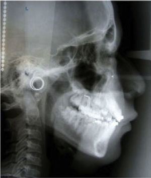 Post-treatment lateral headfilms.
