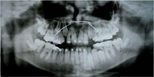 Post-treatment panoramic radiographs.