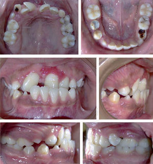 Initial intraoral photographs.