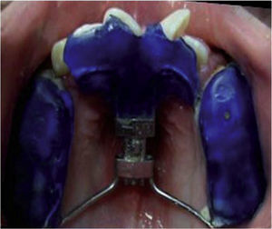 cclusal view of the Bite Blovk-type device once the activation was finished.