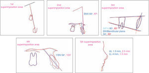 Superimposition areas.