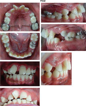 Post-treatment intraoral photographs.
