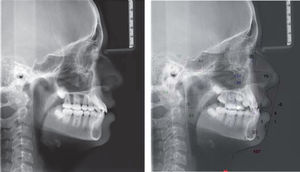 Radiografía lateral de cráneo final, superposición y comparación de medidas.