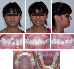 Face, arches and occlusion pre-treatment photographs.