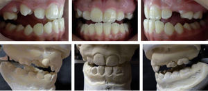 Clinical functional analysis and articulator mounting.