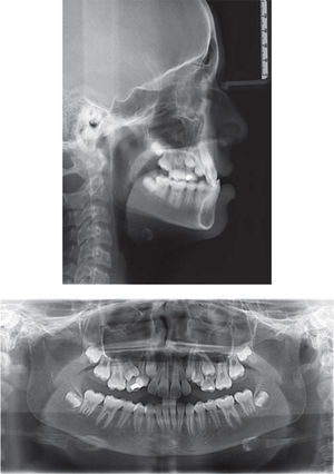 Initial lateral headfilm and panoramic radiograph.
