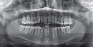 Radiografía panorámica.