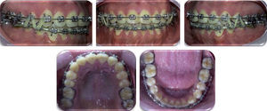 Fase de asentamiento oclusal.