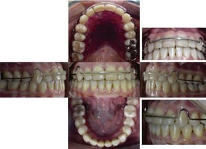 Retenedor fijo inferior y removible circunferencial superior.