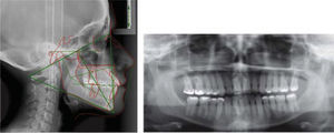 Final radiographs.