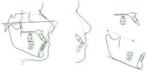 Super impositions. Initial: red, final: blue Color image available atwww.medigraphic.com/ortodoncia.