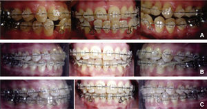 Treatment progress: A) SKL archwire, B) Class III elastics, vertical vector, and C) Space closure (SKL).