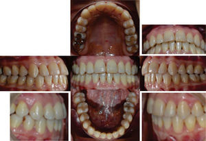 Final intraoral photographs.