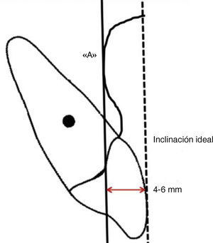 Norma de inclinación del incisivo superior según Mc Namara.