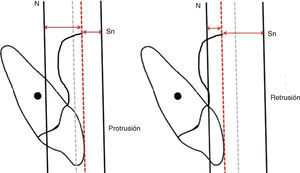 Cuando la línea punteada no se encuentra centrada entre Nasion vertical y subnasal vertical, se observa protrusión o retrusión de los incisivos superiores.