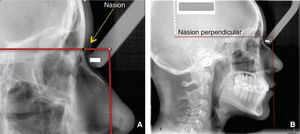 A. Ubicación de nasion. B. Línea Nasion perpendicular a subnasal.