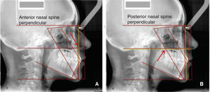 A. Anterior nasal spine. B. Posterior nasal spine.