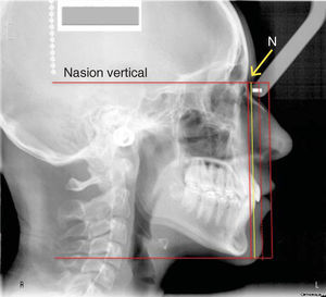Nasion vertical line.