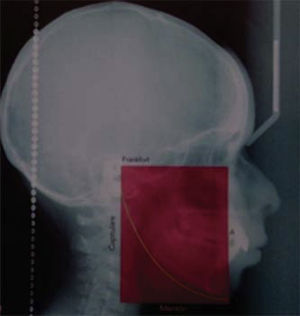 Paciente dolicofacial. La altura anterior del cuadro es mayor que la profundidad superior por más de un centímetro.