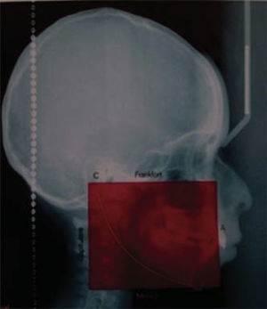 Brachifacial patient. The anterior height of the box is smaller than the upper depth by more than a centimeter.